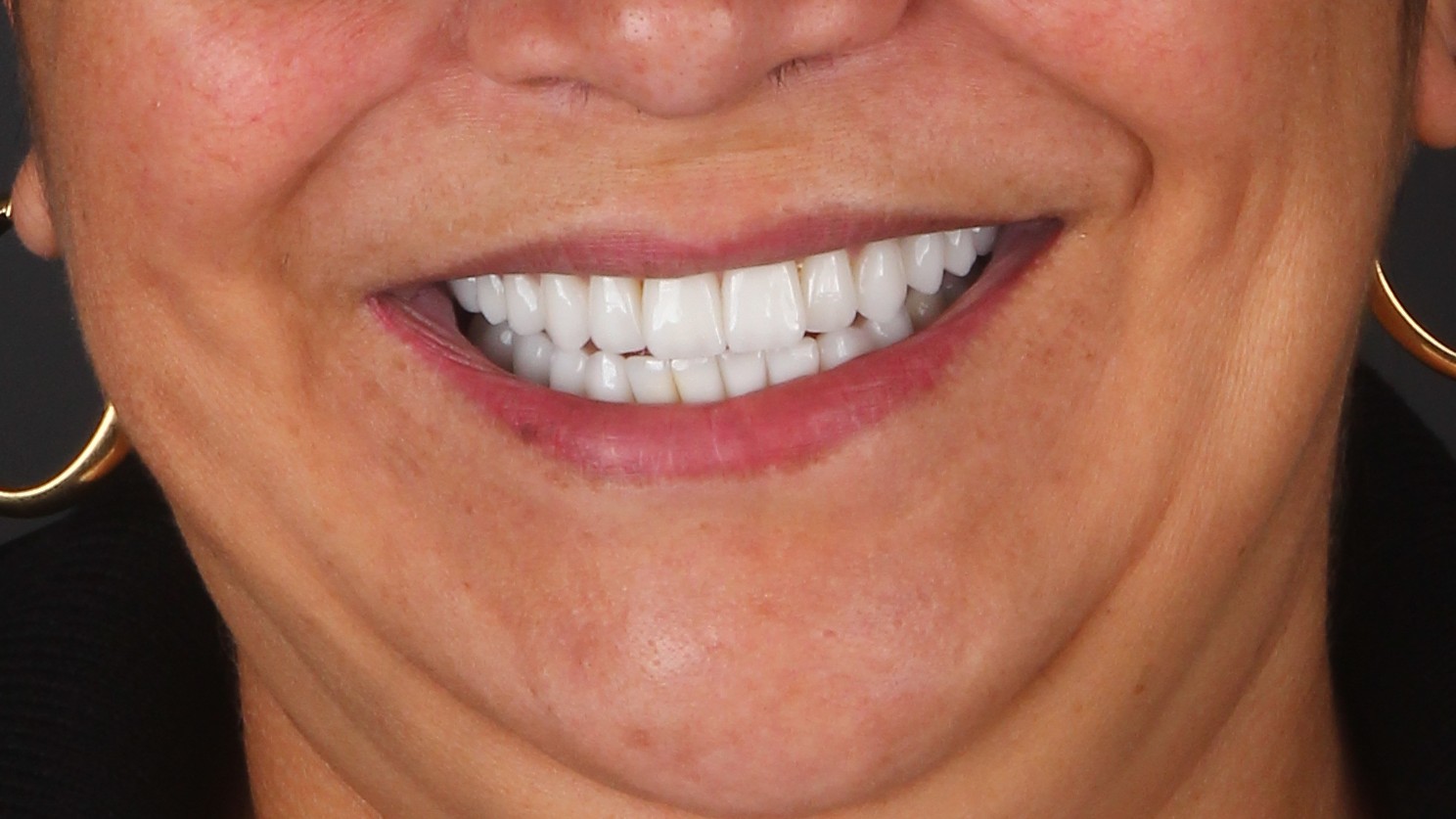 Sorriso com facetas dentárias para ilustrar a comparação entre resina e porcelana
