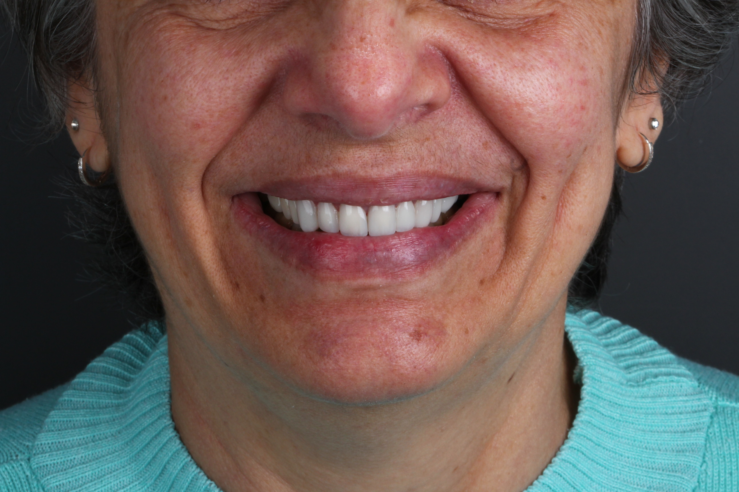 Sorriso com lentes dentais para ilustrar o planejamento e preparo dos dentes