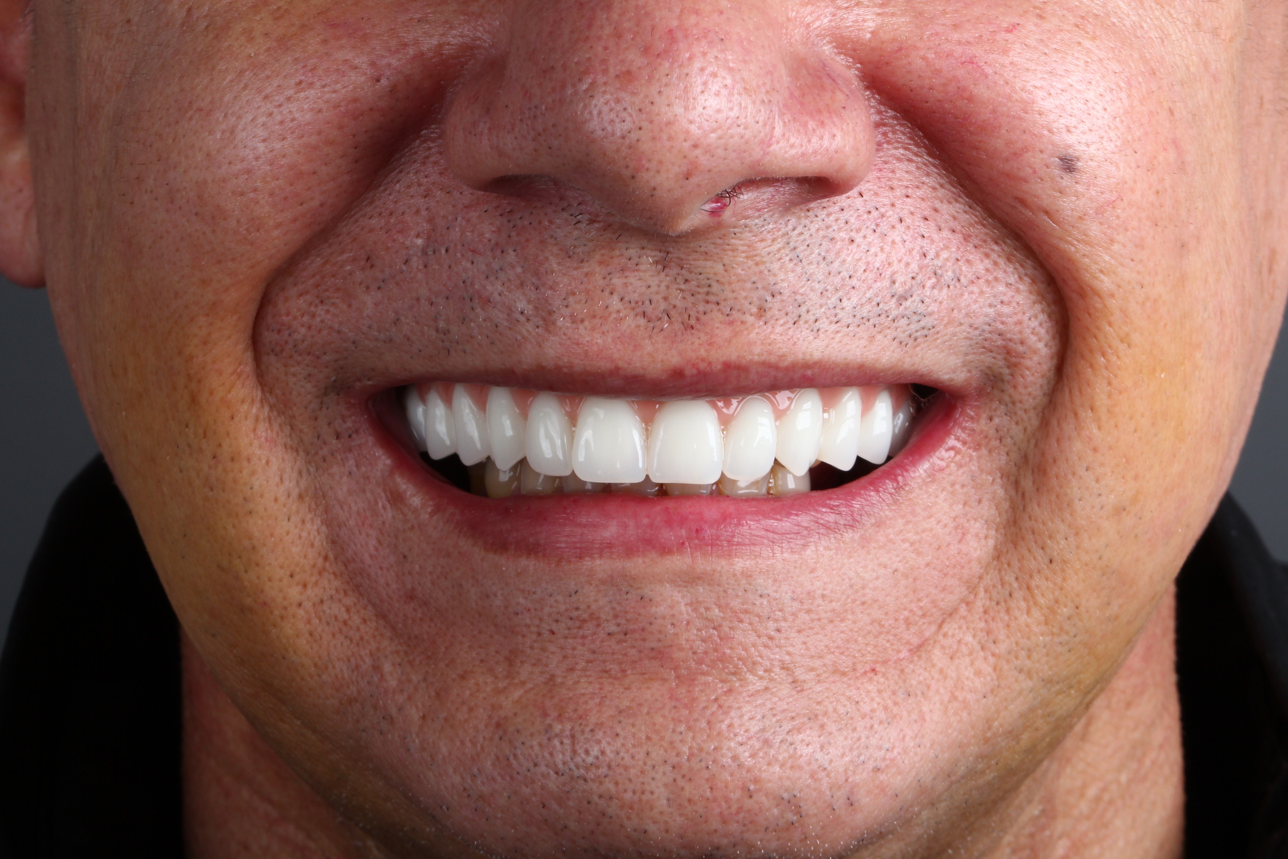 Sorriso de paciente fotografado de perto