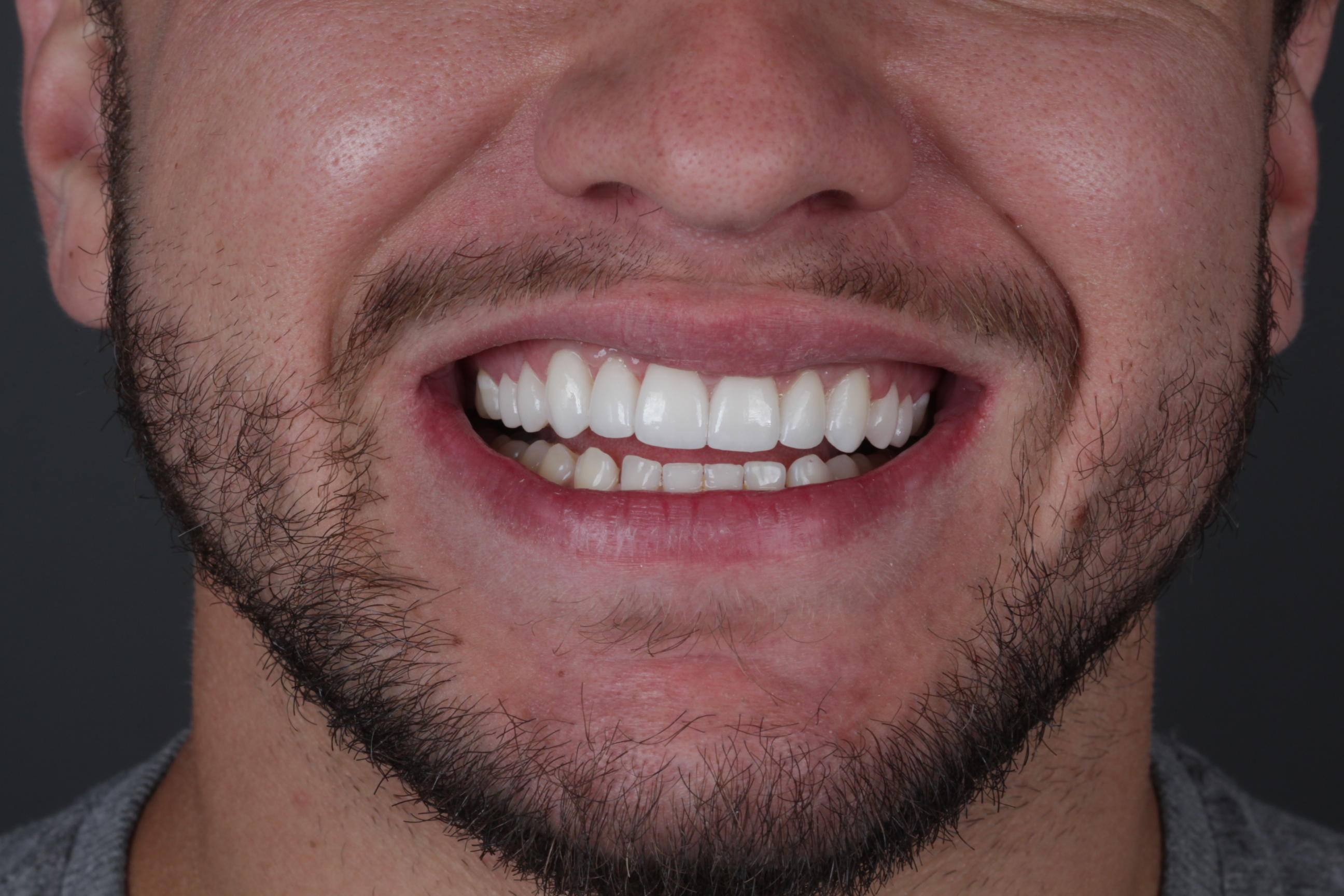 Sorriso com lentes dentais para ilustrar o planejamento do tratamento