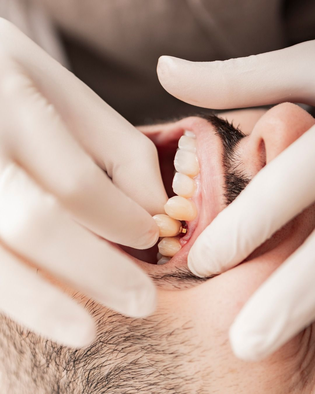 Implantes dentários